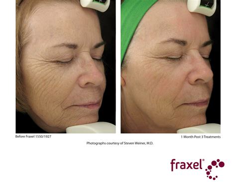 Fraxel Dual Laser .